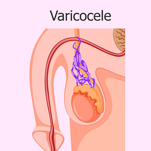 Varicocele: o que é, causas, diagnóstico e tratamento